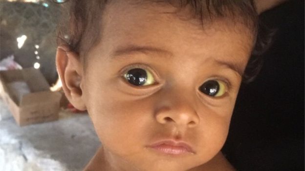 تعاني أسماء أحمد، البالغة من العمر تسعة أشهر، من سوء التغذية ومرض الصفراء.