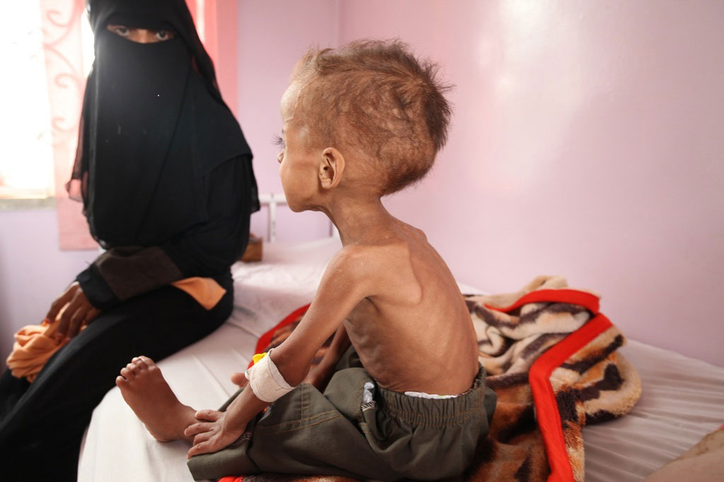 537,000 Yemeni Children Face &#39;Severe Malnutrition&#39; amid Saudi Aggression 