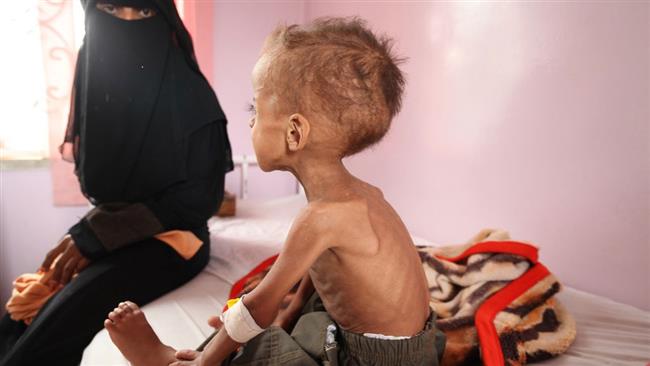 Más de un millón de niños yemeníes sufren desnutrición por la agresión saudí