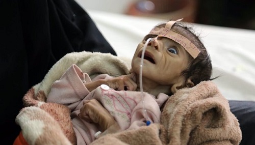 اليونيسف: 2.2 مليون طفل يمني يعانون من سوء التغذية الحاد والوضع أصبح كارثياً+صور