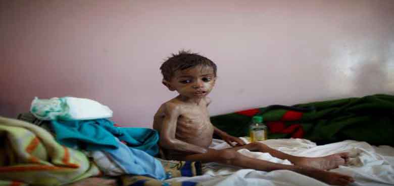 یمن، 1 کروڑ 40 لاکھ افراد غذائی قلت کا شکار