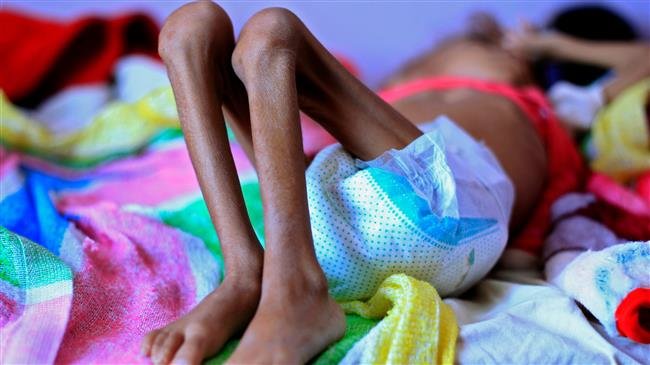 14 Million Yemeni on Brink of Famine: NGOs