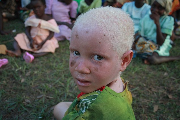 El infierno de ser albino en África: una verdad aterradora