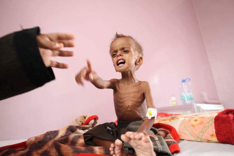 اليونيسيف: 80 بالمئة من سكان اليمن يواجهون خطر نقص الغذاء والإصابة بالأمراض