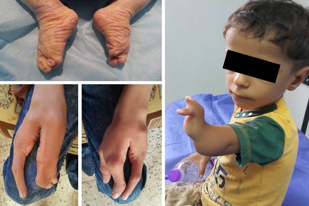 Iraqi Children Born Near US Military Base Show Elevated Rates of ’Serious Congenital Deformities: Study