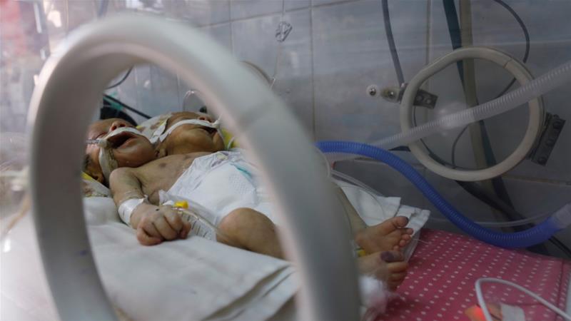 Yemeni Conjoined Twins Die AS Saudi Blockade Prevents Taking Them Abroad