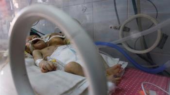 Yemeni Conjoined Twins Die AS Saudi Blockade Prevents Taking Them Abroad