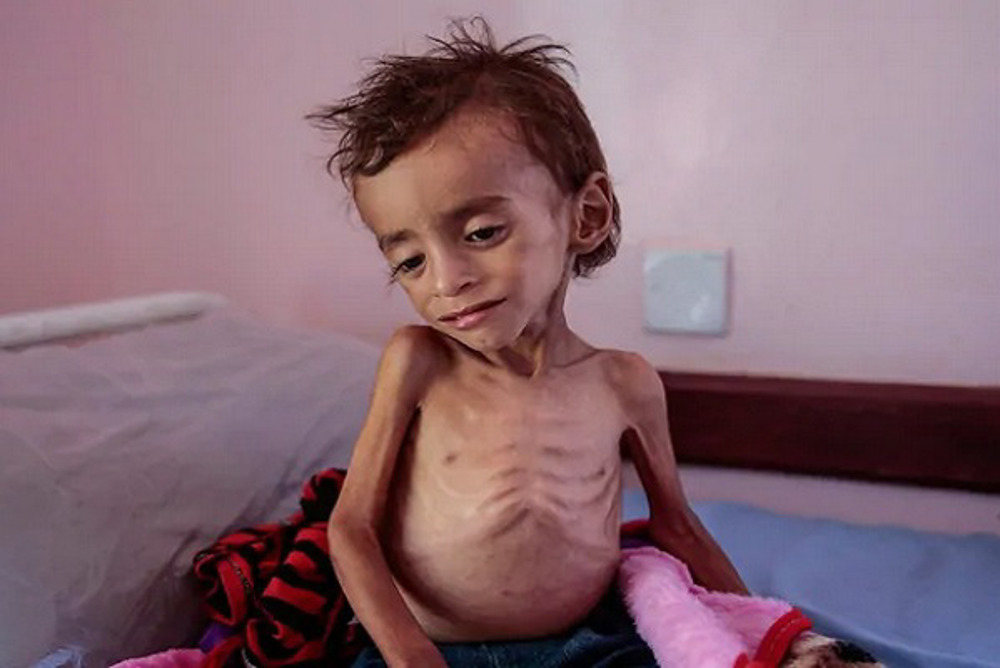 1 Yemeni Child Dies Every 10 Minutes amid Saudi-Led Aggression: UNICEF