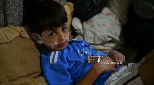 الأمم المتحدة: ارتفاع نسبة الأمراض والحالات المعدية لدى النازحين في غزة