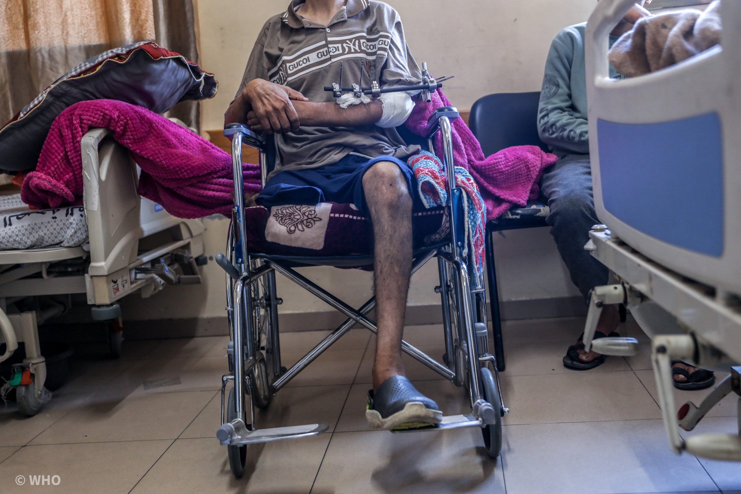 الصحة الفلسطينية: 6 آلاف حالة بتر بحاجة إلى برامج تأهيل عاجلة طويلة الأمد