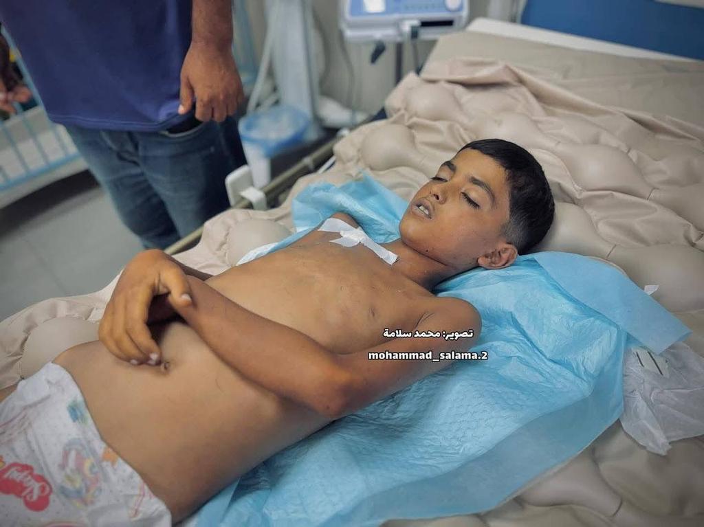 الفرا: ارتفاع عدد الوفيات بسبب الشلل المتصاعد في غزة لـ 5 بينهم 4 أطفال