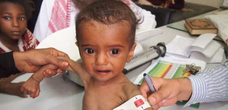 Unicef: Más de dos millones de niños sufren desnutrición severa en Yemen