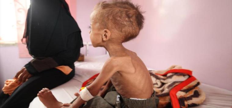 ONU: 850 mil niños yemeníes sufren desnutrición severa