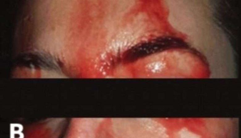 Desconcierta a médicos joven mujer italiana que suda sangre por manos y cara