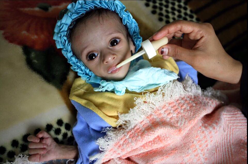 Over 70% of Yemenis in Need of Humanitarian Aids: UN Says as Saudi Aggression Continues