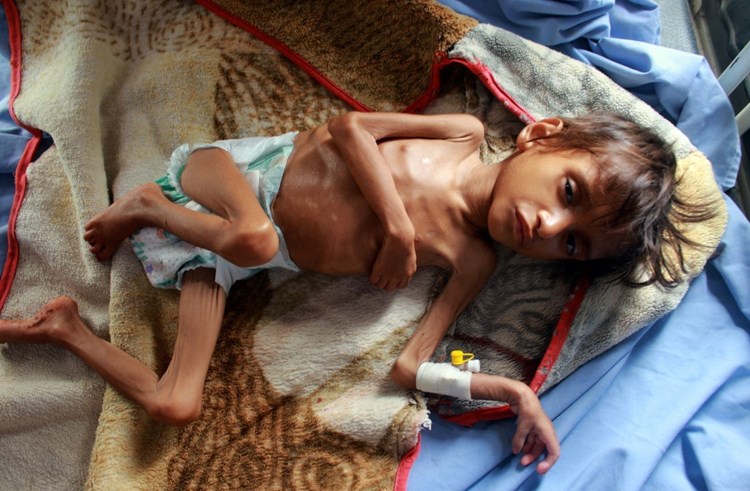 منظمة الأمم المتحدة: اليمنيون يتضورون جوعاً ومعرضون لخطر الموت